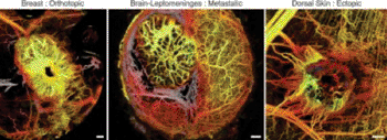 Image: The new imaging tool reveals strikingly different networks of blood vessels surrounding different types of tumors in a mouse model. Left: breast cancer in the breast. Middle: metastatic breast cancer in the brain. Right: ectopic breast cancer in the skin (Photo courtesy of Nature Medicine).